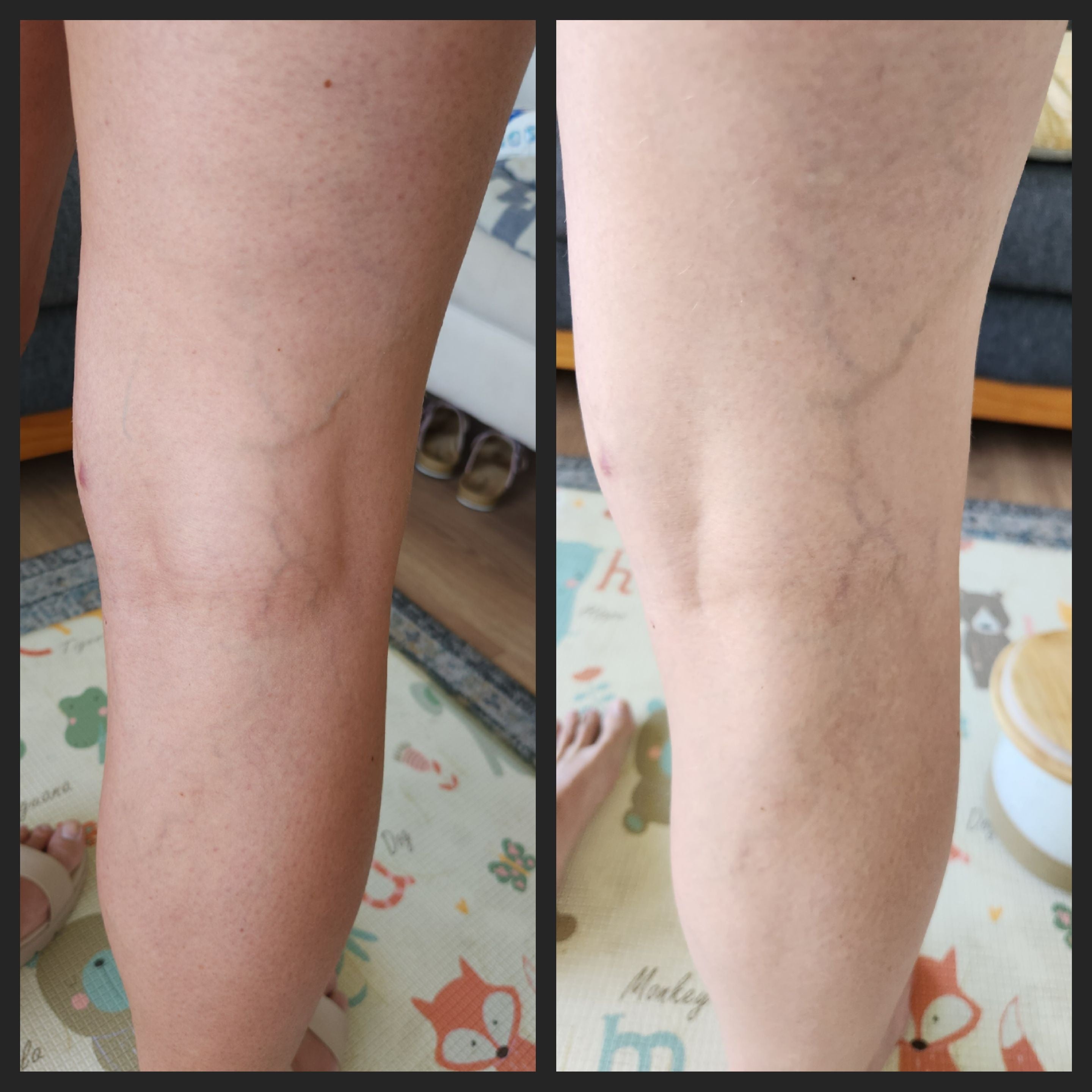 autobronceante para ocultar venas